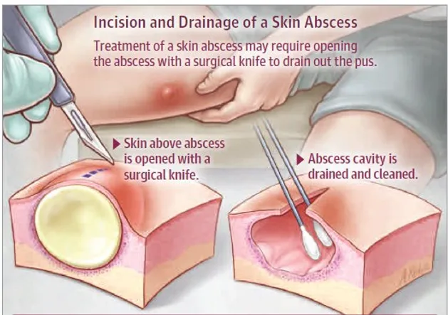 incision and drainage of abscess