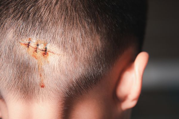 sutures over scalp