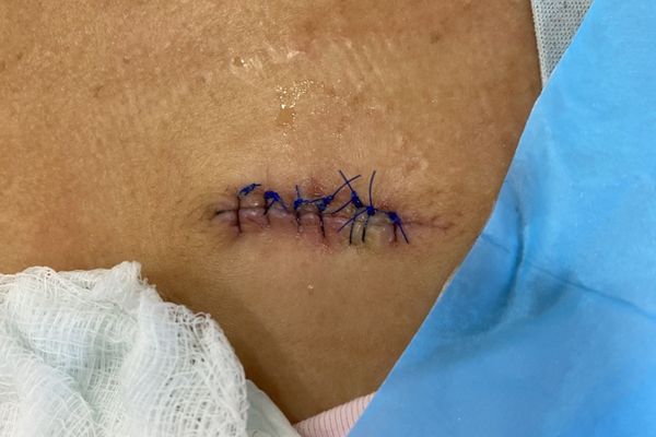 sutures over a wound