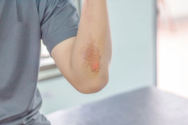abrasion over elbow