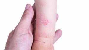 eczema dry skin