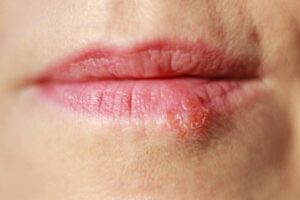 herpes cold sores