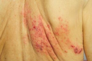 painful shingles rashes