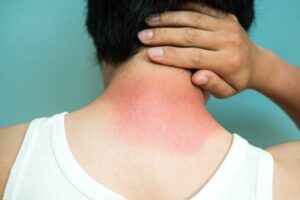 superficial sunburn of skin