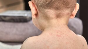 child with viral rashes