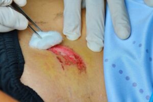 cleaning skin wound